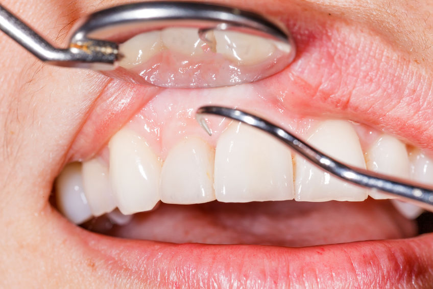 tratamentos periodontais