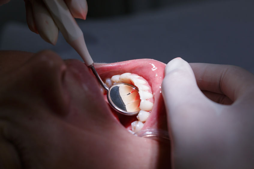 doenças periodontais