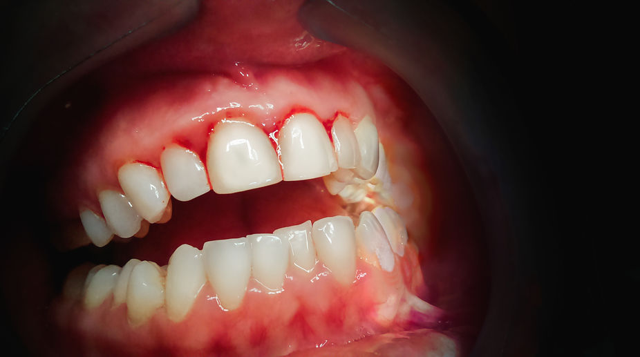 Doença periodontal necrosante