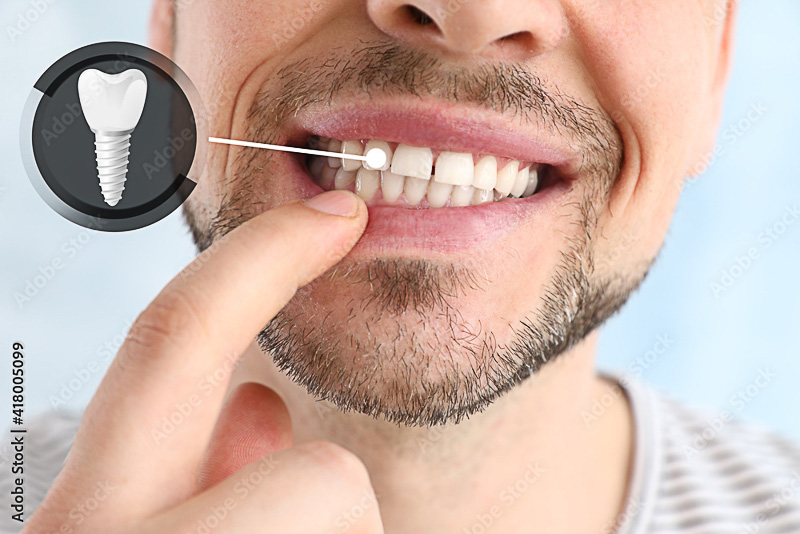 Fio dental: 5 dicas para usar corretamente - Dr. Sérgio Caetano