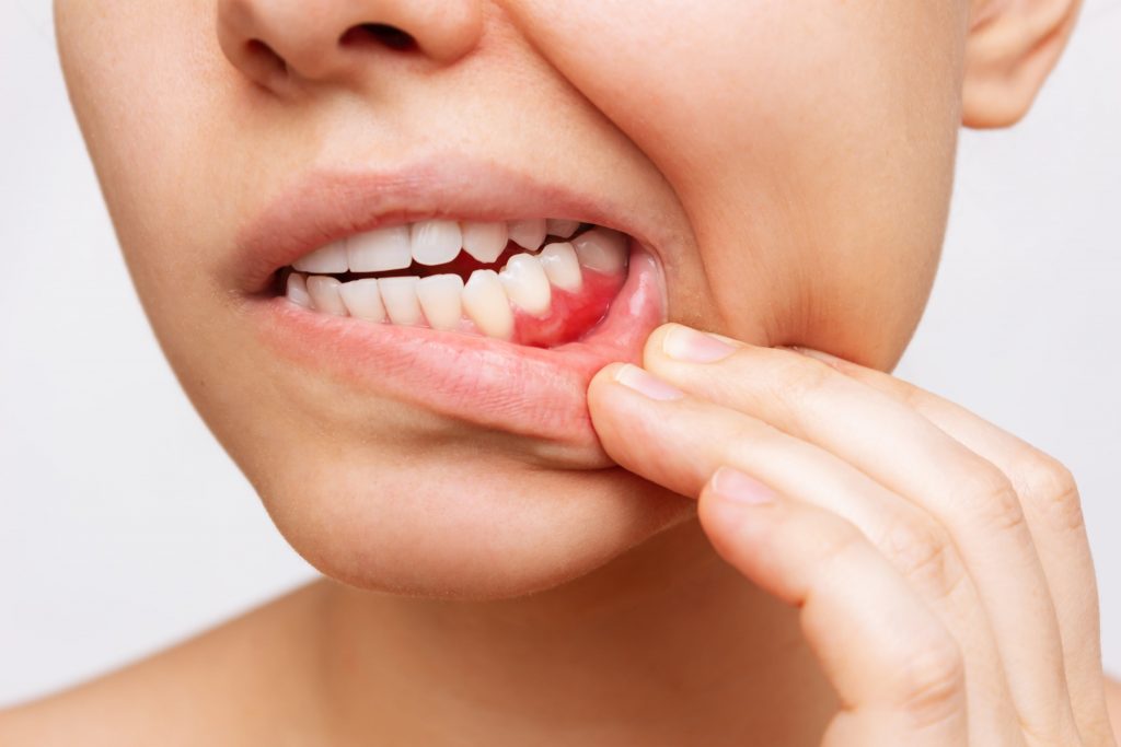 Doença periodontal